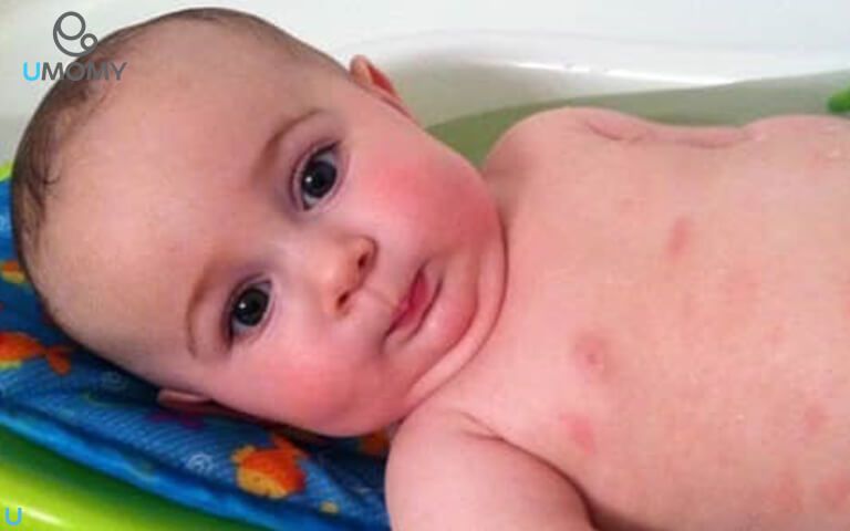 دلایل جوش های ریز روی صورت و بدن نوزاد + آموزش درمان