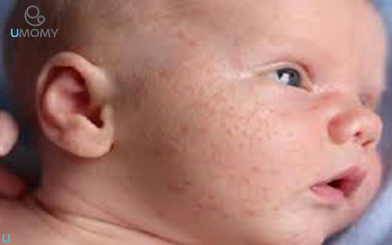 روش‌های دارویی برای درمان جوش های ریز روی صورت نوزاد