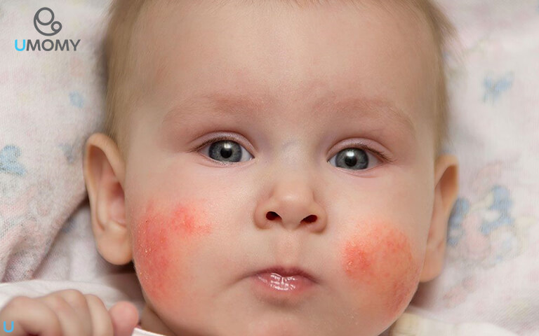 دلایل جوش های ریز روی صورت و بدن نوزاد + آموزش درمان